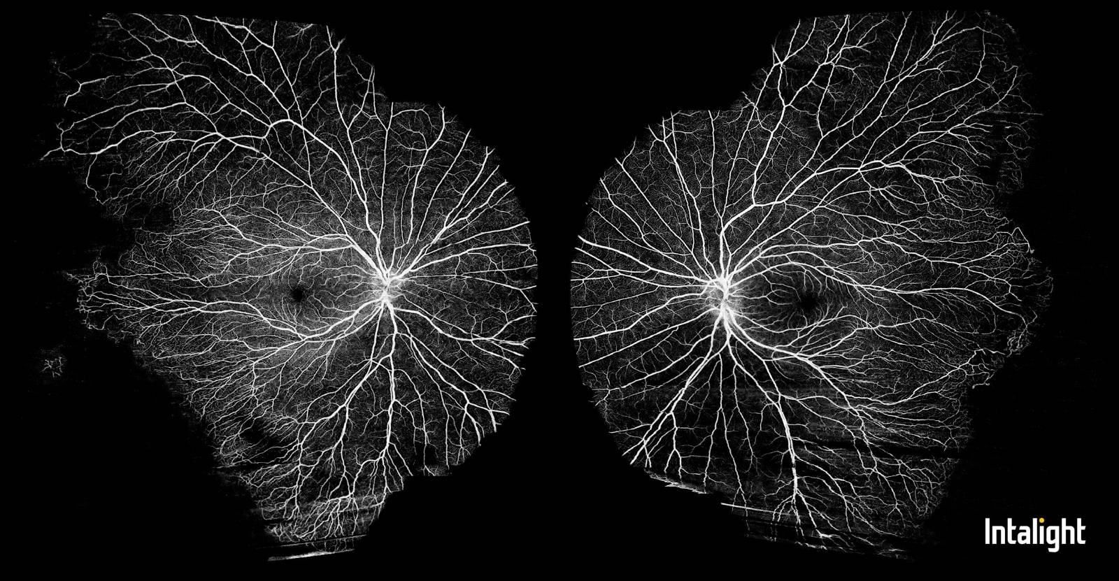Familiárna exudatívna vitreoretinopatia