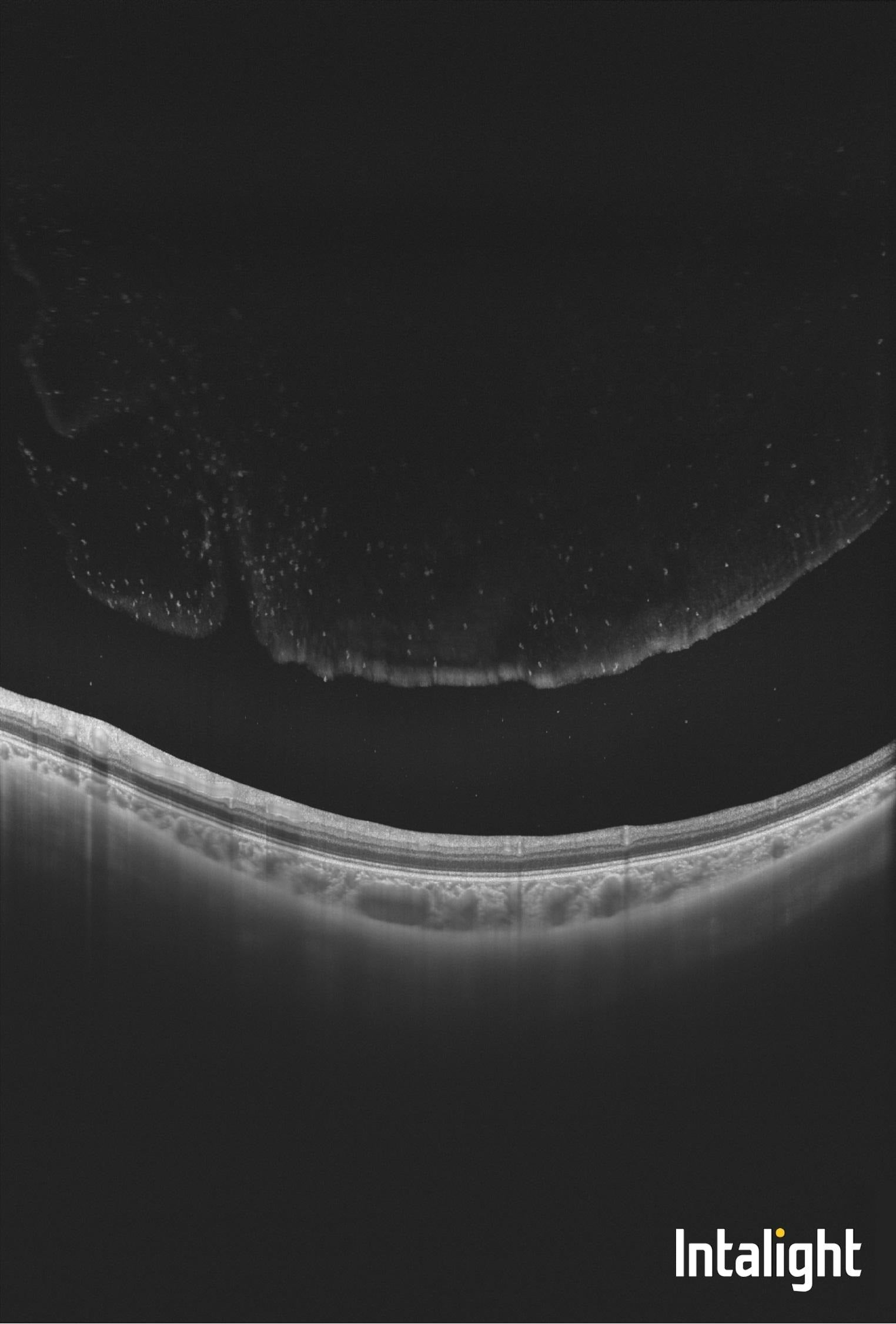 Intramediárna uveitída