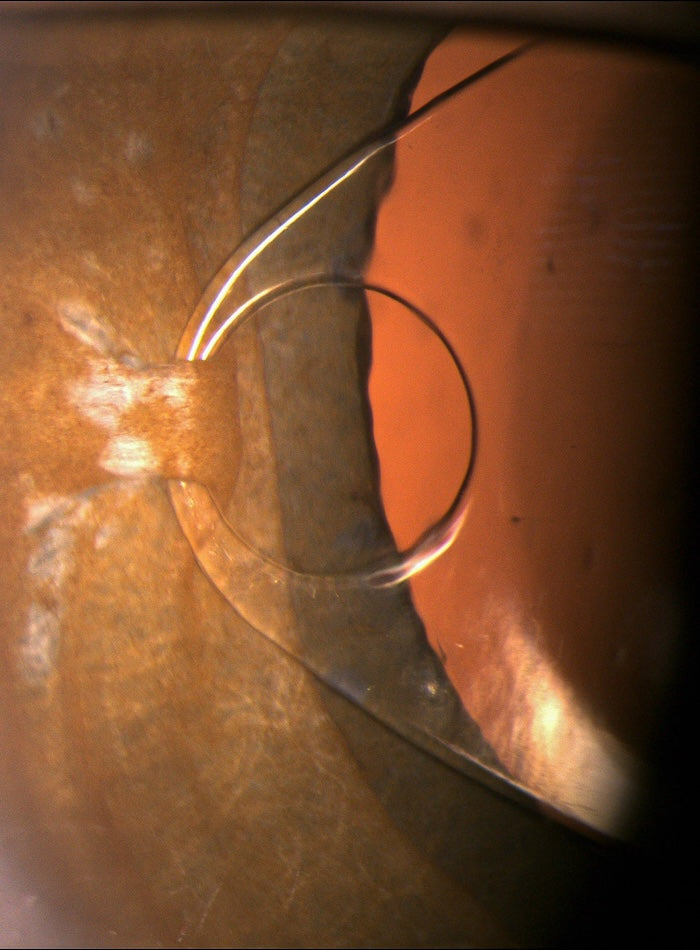 Detail uchytenia vnútroočnej šošovky typu Iris Claw vyhotovený štrbinovou lampu Mediworks oftalmologickým technikom Ing. Filipom Kecerom z firmy Medecor Slovensko