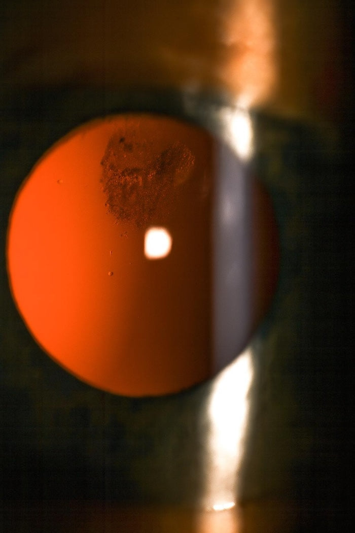 Subkapsulárna katarakta