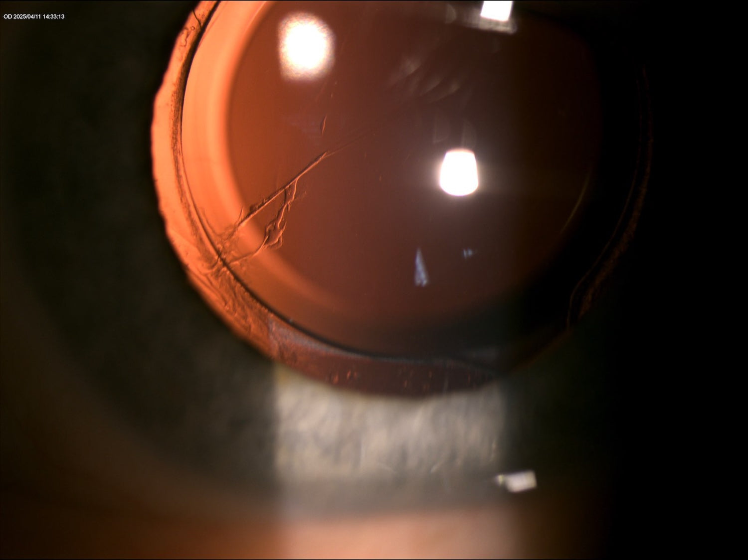 Detail technika retroiluminácie vyhotovený štrbinovou lampu Mediworks oftalmologickým technikom Ing. Filipom Kecerom z firmy Medecor Slovensko