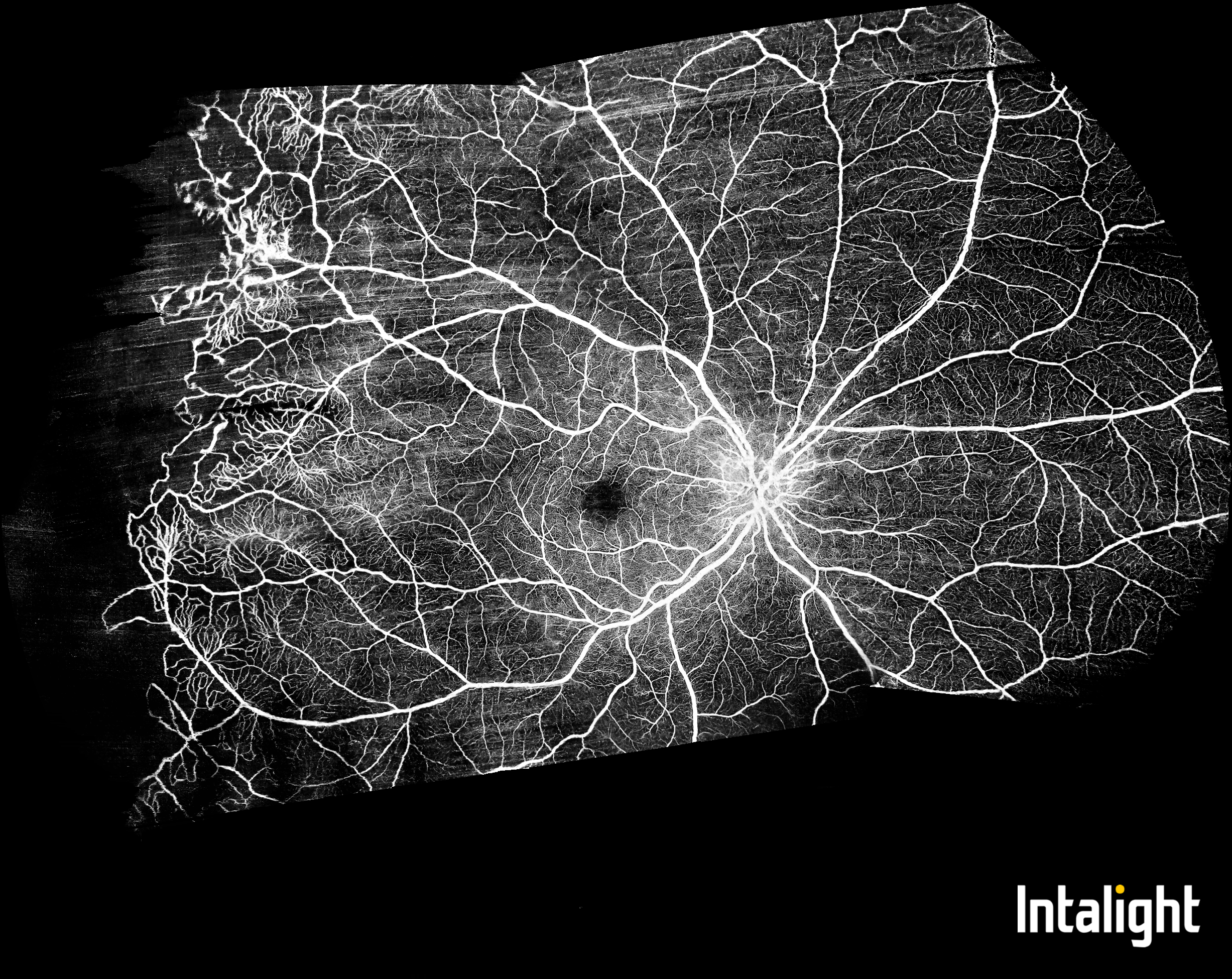 Teleangiektázia a oklúzia periférnych sietnicových kapilár
